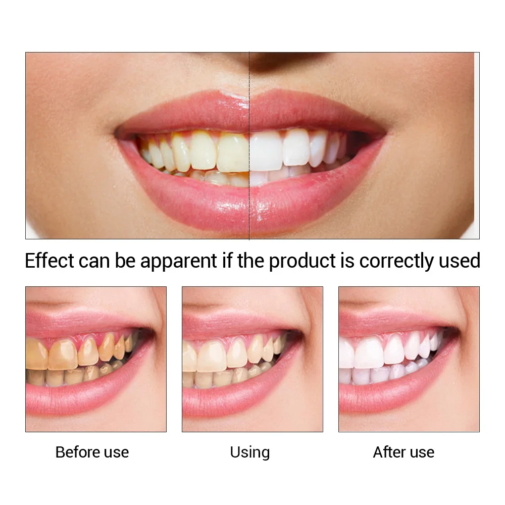 FTEENPLY diş beyazlatma özü to - Teeth Whitening Hismile incelemesi ve fiyatı